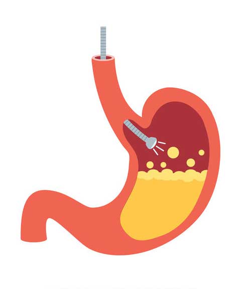 Endoscopie et fibroscopie